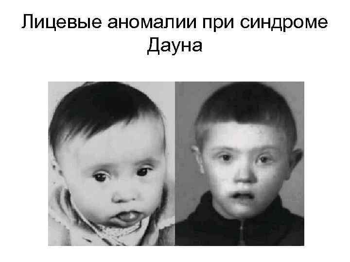 Лицевые аномалии при синдроме Дауна 