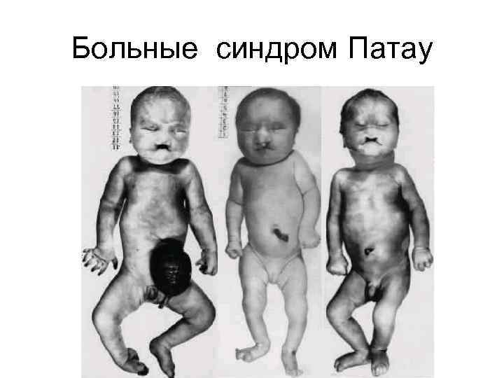 Больные синдром Патау 