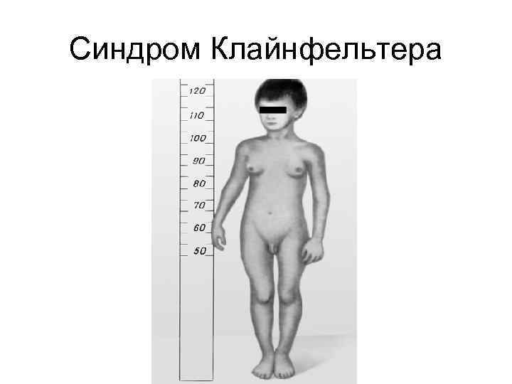 Синдром Клайнфельтера 
