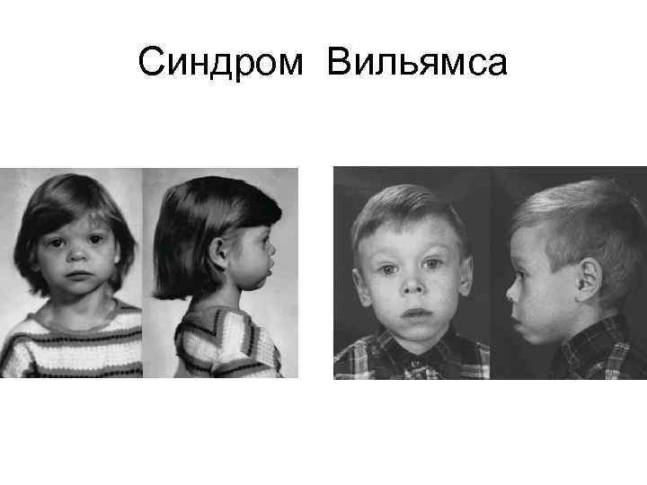 Синдром Вильямса 