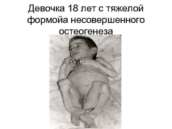 Девочка 18 лет с тяжелой формойа несовершенного остеогенеза 