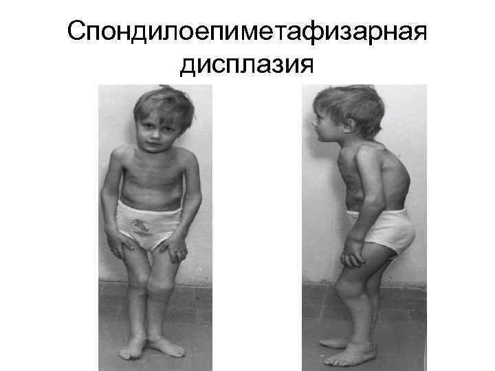 Спондилоепиметафизарная дисплазия 