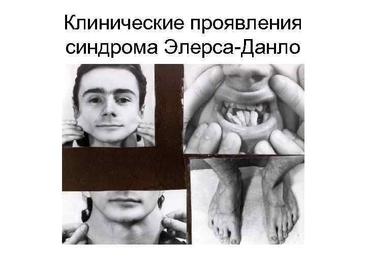 Клинические проявления синдрома Элерса-Данло 
