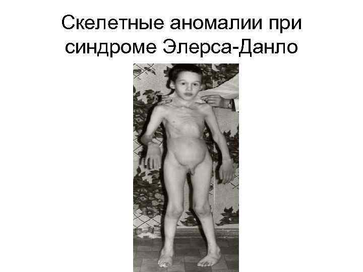 Скелетные аномалии при синдроме Элерса-Данло 