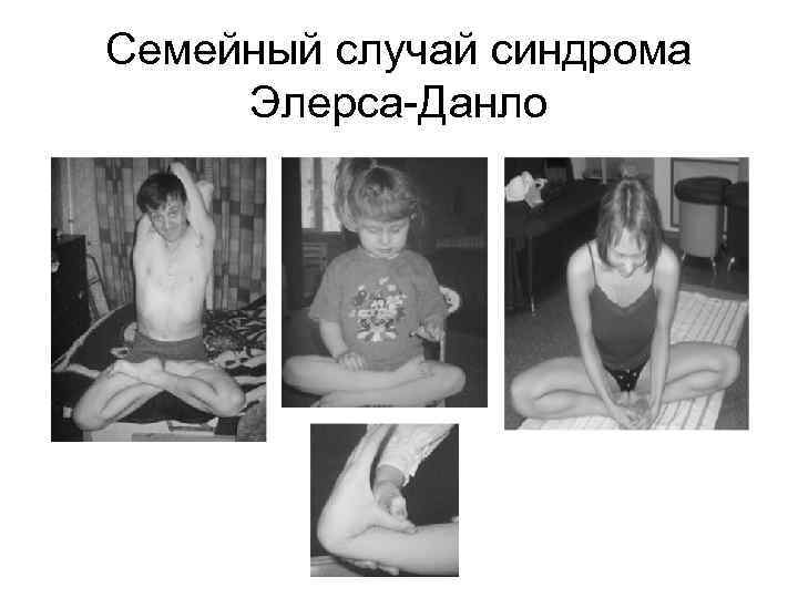 Семейный случай синдрома Элерса-Данло 