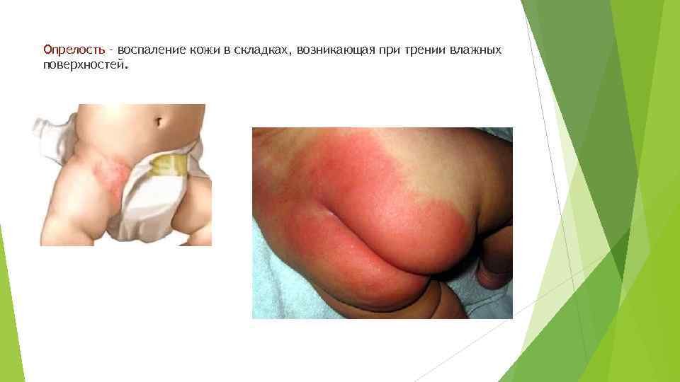 Опрелость – воспаление кожи в складках, возникающая при трении влажных поверхностей. 