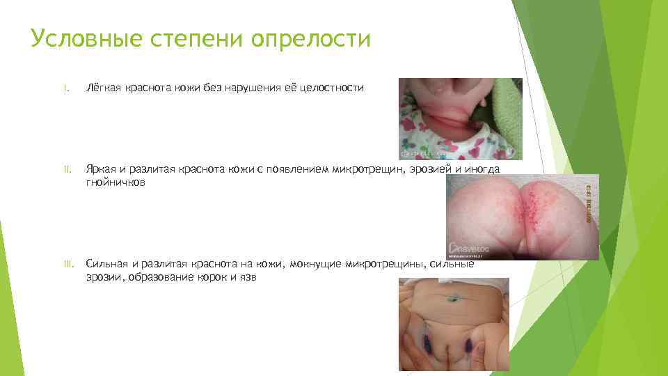 Условные степени опрелости I. Лёгкая краснота кожи без нарушения её целостности II. Яркая и