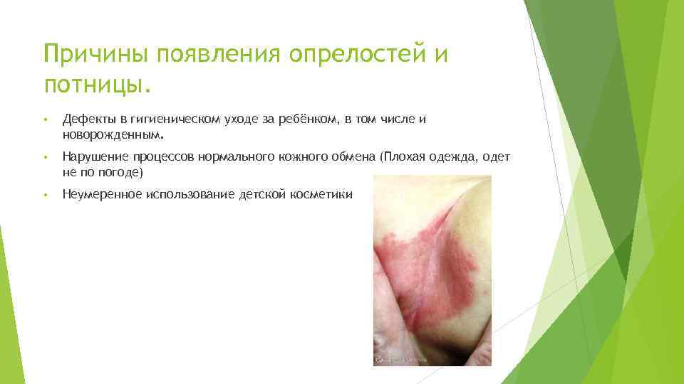 Причины появления опрелостей и потницы. • Дефекты в гигиеническом уходе за ребёнком, в том
