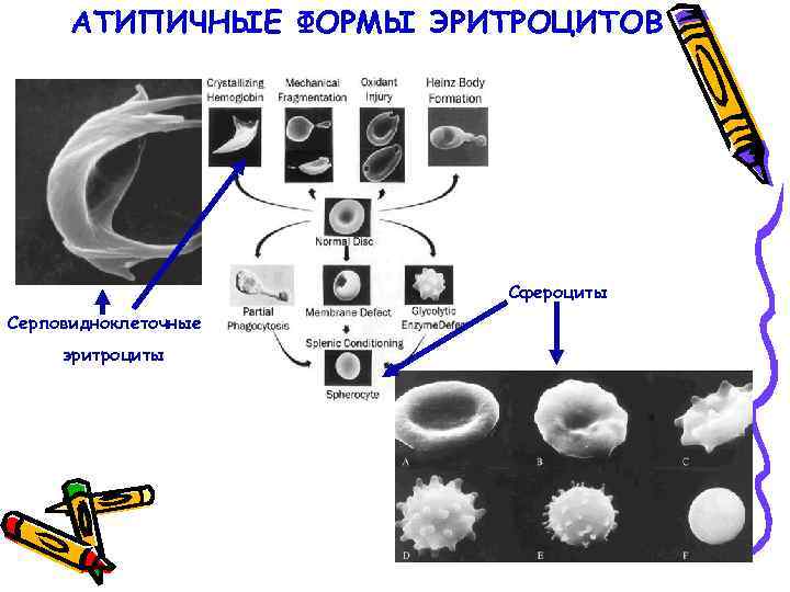 АТИПИЧНЫЕ ФОРМЫ ЭРИТРОЦИТОВ Сфероциты Серповидноклеточные эритроциты 