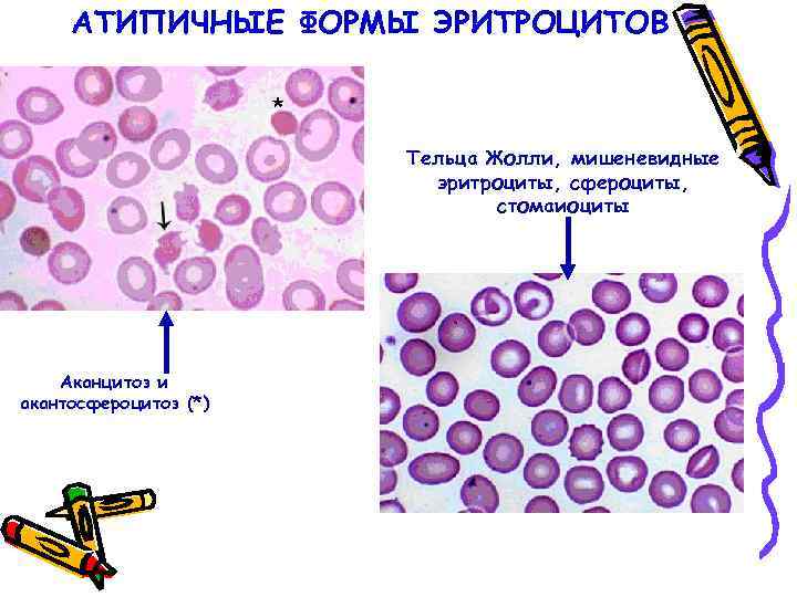 АТИПИЧНЫЕ ФОРМЫ ЭРИТРОЦИТОВ Тельца Жолли, мишеневидные эритроциты, сфероциты, стомаиоциты Аканцитоз и акантосфероцитоз (*) 