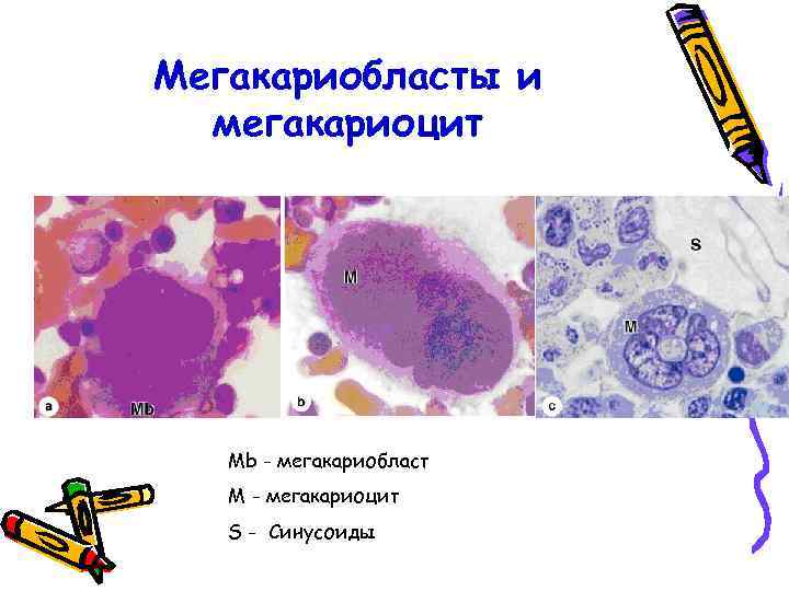 Мегакариобласты и мегакариоцит Mb - мегакариобласт M - мегакариоцит S - Синусоиды 