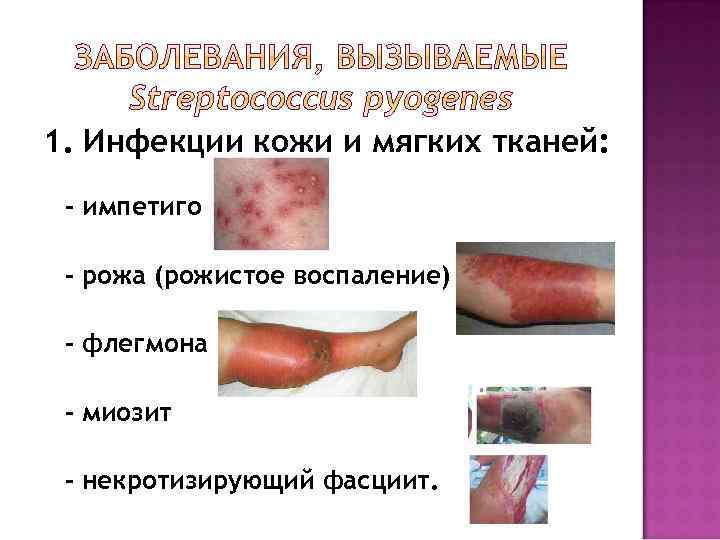 1. Инфекции кожи и мягких тканей: - импетиго - рожа (рожистое воспаление) - флегмона