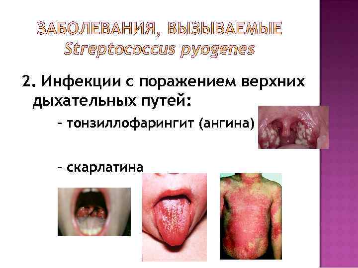 2. Инфекции с поражением верхних дыхательных путей: - тонзиллофарингит (ангина) - скарлатина 
