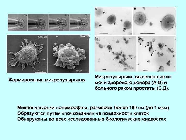 Формирование микропузырьков Микропузырьки, выделенные из мочи здорового донора (А, В) и больного раком простаты