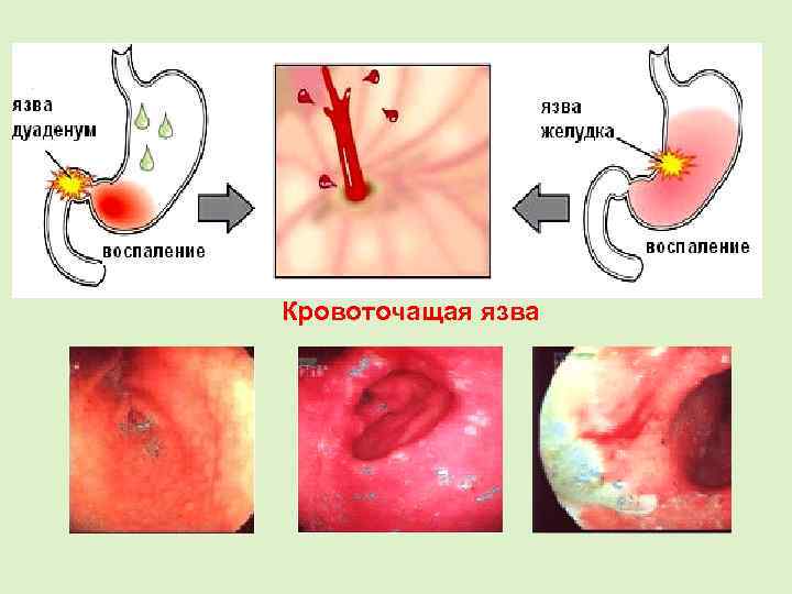 Кровоточащая язва 