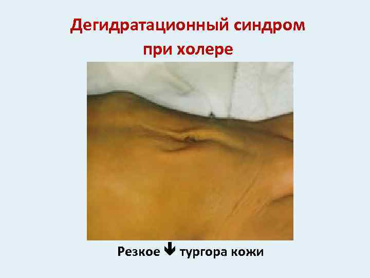 Дегидратационный синдром при холере Резкое тургора кожи 