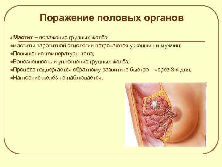 Поражение половых органов 4. Мастит – поражение грудных желёз; маститы паротитной этиологии встречаются у
