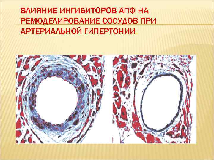 ВЛИЯНИЕ ИНГИБИТОРОВ АПФ НА РЕМОДЕЛИРОВАНИЕ СОСУДОВ ПРИ АРТЕРИАЛЬНОЙ ГИПЕРТОНИИ. 