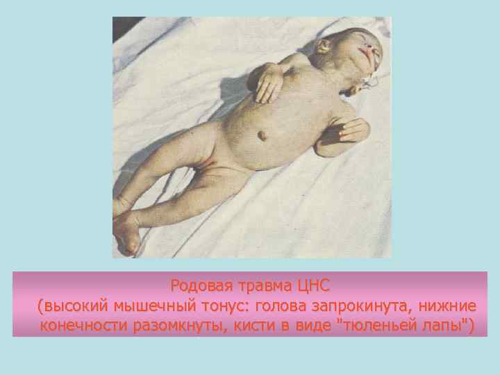 Родовая травма ЦНС (высокий мышечный тонус: голова запрокинута, нижние конечности разомкнуты, кисти в виде