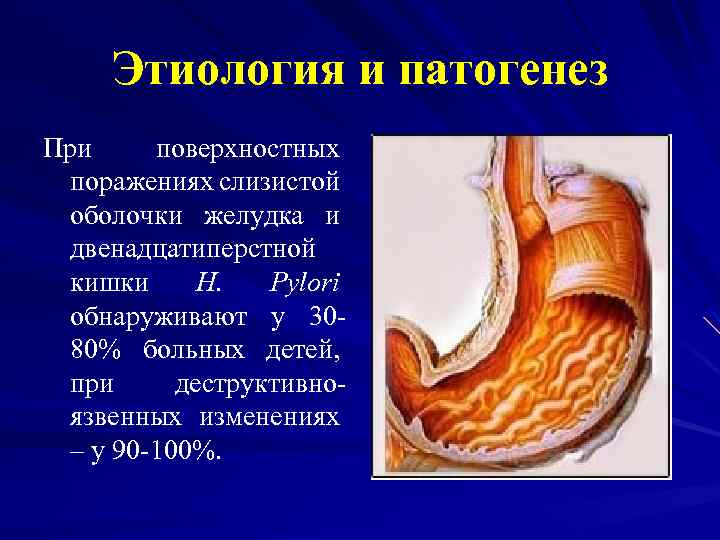 Этиология и патогенез При поверхностных поражениях слизистой оболочки желудка и двенадцатиперстной кишки H. Pylori