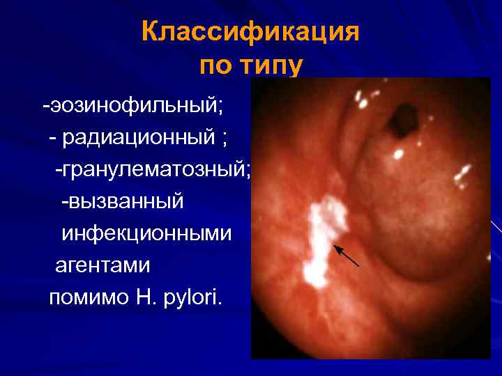Классификация по типу -эозинофильный; - радиационный ; -гранулематозный; -вызванный инфекционными агентами помимо H. pylori.