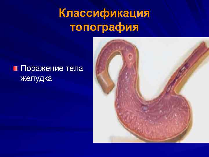 Классификация топография Поражение тела желудка 