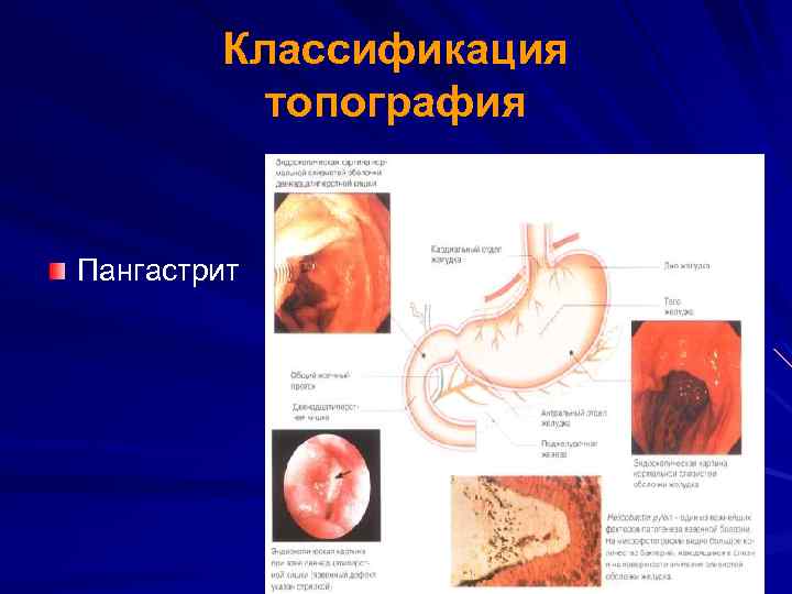 Классификация топография Пангастрит 