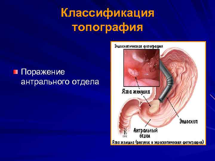 Классификация топография Поражение антрального отдела 