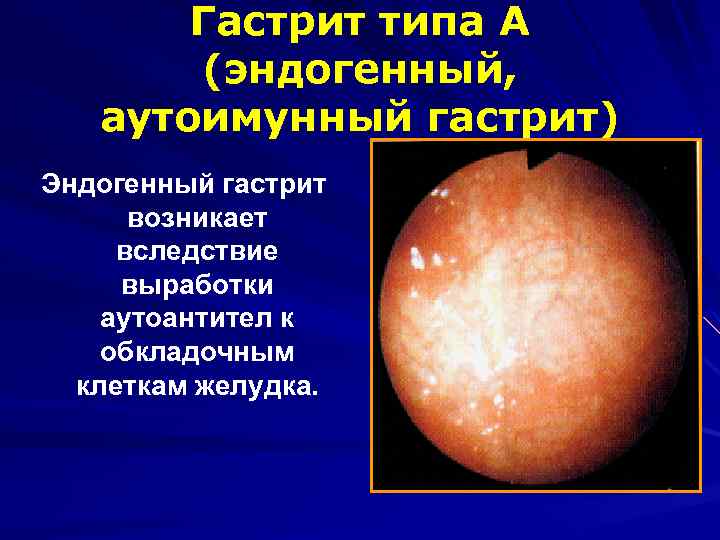 Гастрит типа А (эндогенный, аутоимунный гастрит) Эндогенный гастрит возникает вследствие выработки аутоантител к обкладочным