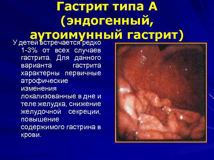 Гастрит типа А (эндогенный, аутоимунный гастрит) У детей встречается редко 1 -3% от всех