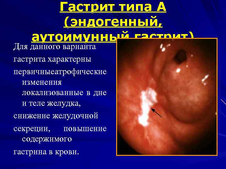 Гастрит типа А (эндогенный, аутоимунный гастрит) Для данного варианта гастрита характерны первичные атрофические изменения