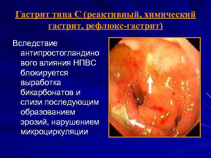 Гастрит типа С (реактивный, химический гастрит, рефлюкс-гастрит) Вследствие антипростогландино вого влияния НПВС блокируется выработка