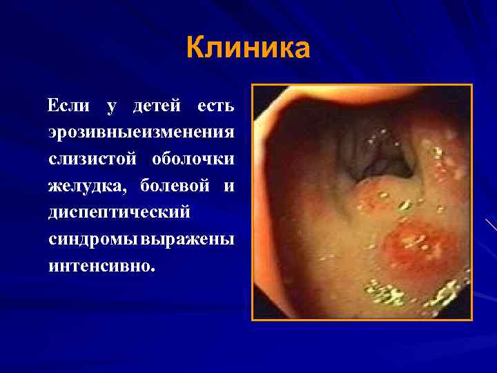 Клиника Если у детей есть эрозивныеизменения слизистой оболочки желудка, болевой и диспептический синдромы выражены