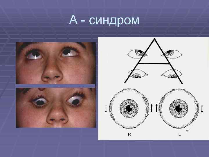 А - синдром 