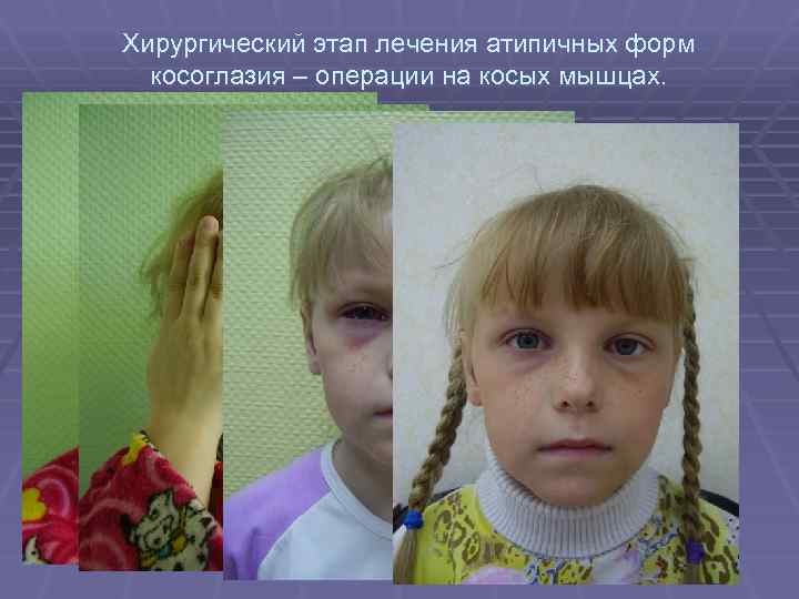 Хирургический этап лечения атипичных форм косоглазия – операции на косых мышцах. 