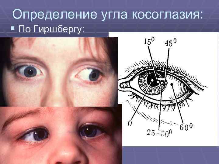 Определение угла косоглазия: § По Гиршбергу: 