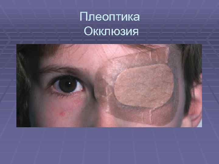 Плеоптика Окклюзия 