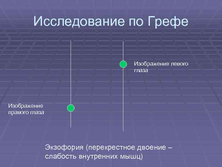 Исследование по Грефе Изображение левого глаза Изображение правого глаза Экзофория (перекрестное двоение – слабость