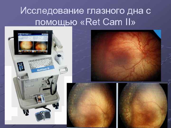 Исследование глазного дна с помощью «Ret Cam II» 