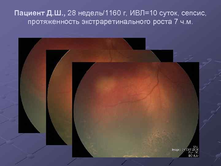 Пациент Д. Ш. , 28 недель/1160 г, ИВЛ=10 суток, сепсис, протяженность экстраретинального роста 7
