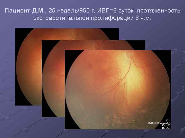 Пациент Д. М. , 25 недель/950 г, ИВЛ=6 суток, протяженность экстраретинальной пролиферации 8 ч.