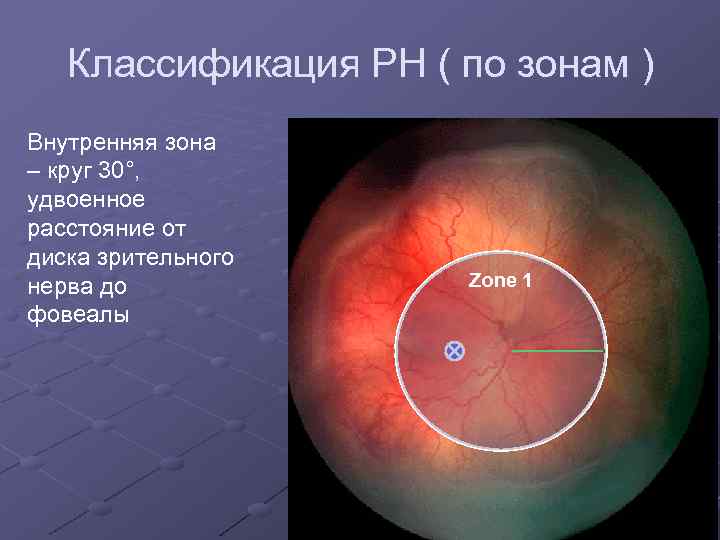 Классификация РН ( по зонам ) Внутренняя зона – круг 30°, удвоенное расстояние от