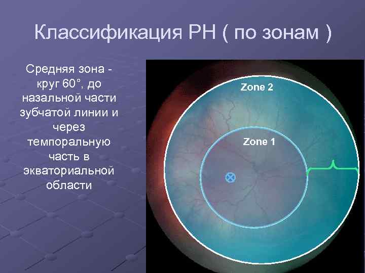 Классификация РН ( по зонам ) Средняя зона круг 60°, до назальной части зубчатой