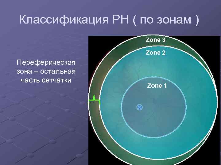 Классификация РН ( по зонам ) Zone 3 Zone 2 Переферическая зона – остальная