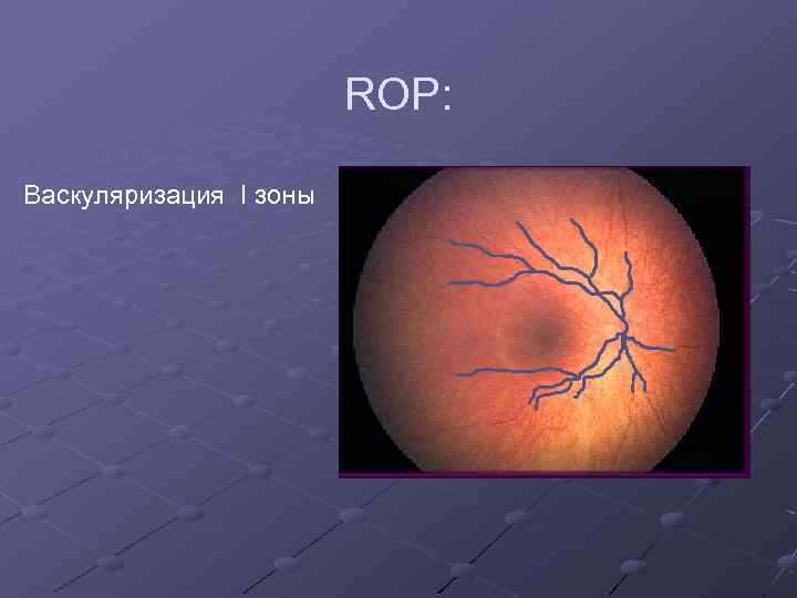 ROP: Васкуляризация I зоны 