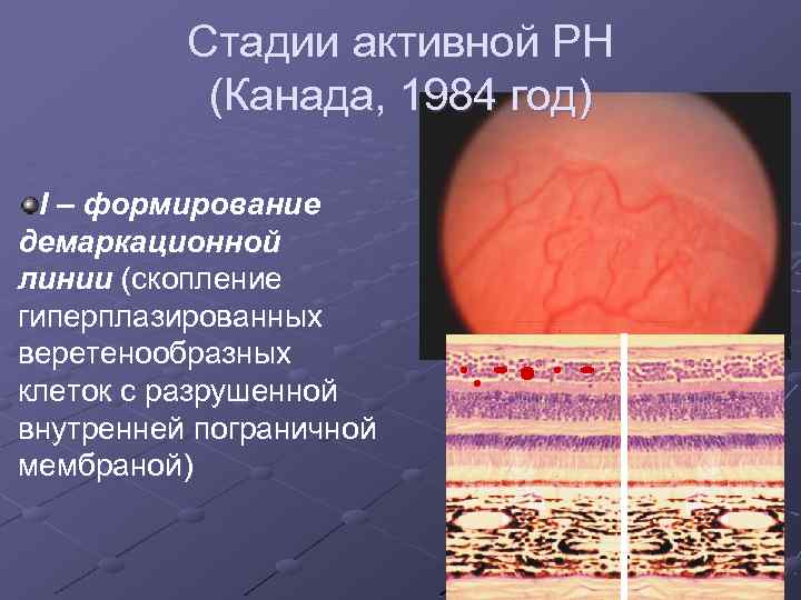 Стадии активной РН (Канада, 1984 год) I – формирование демаркационной линии (скопление гиперплазированных веретенообразных