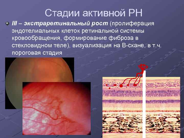 Стадии активной РН III – экстраретинальный рост (пролиферация эндотелиальных клеток ретинальной системы кровообращения, формирование