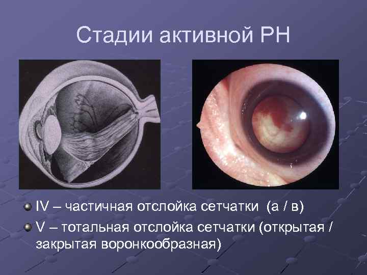 Стадии активной РН IV – частичная отслойка сетчатки (а / в) V – тотальная