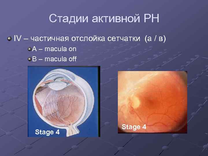 Стадии активной РН IV – частичная отслойка сетчатки (а / в) A – macula