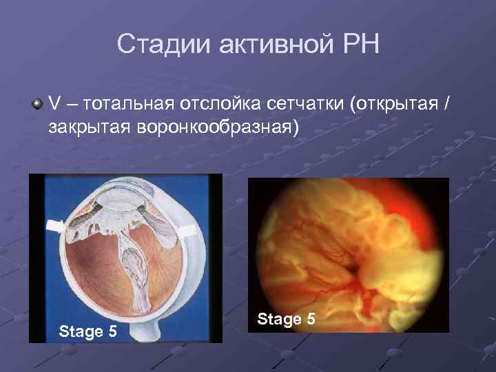 Стадии активной РН V – тотальная отслойка сетчатки (открытая / закрытая воронкообразная) Stage 5